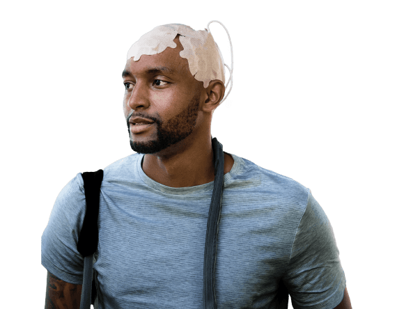 Diagram showing how Optune Go delivers tumor treating fields to the brain using wearable medical device technology