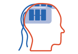 Optune use instructions infographic showing step-by-step guide with medical equipment for brain tumor treatment